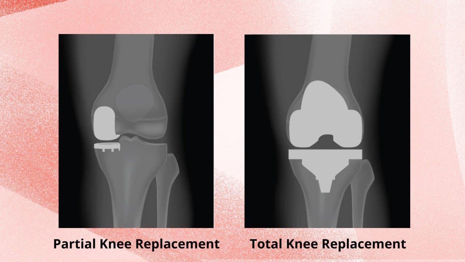 Can You Play Basketball After Knee Replacement? It Depends